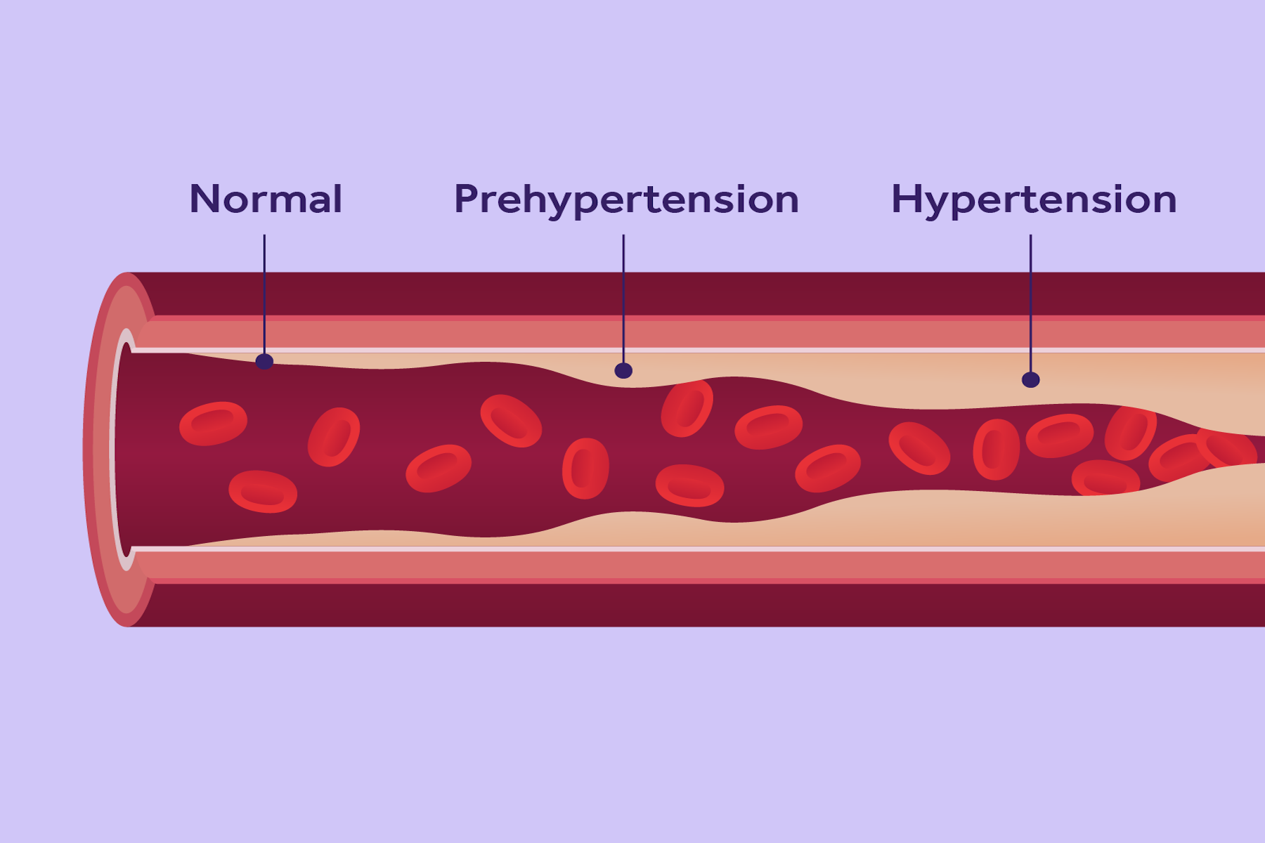 What is high blood pressure.png